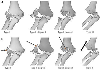 Closed reduction and percutaneous pinning for treatment of unstable lateral condyle fractures of the humerus in children